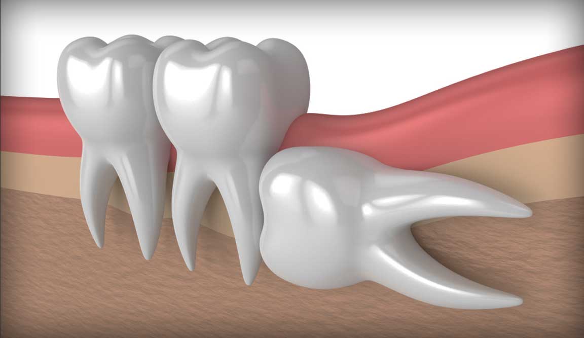 Horizontal-impaction