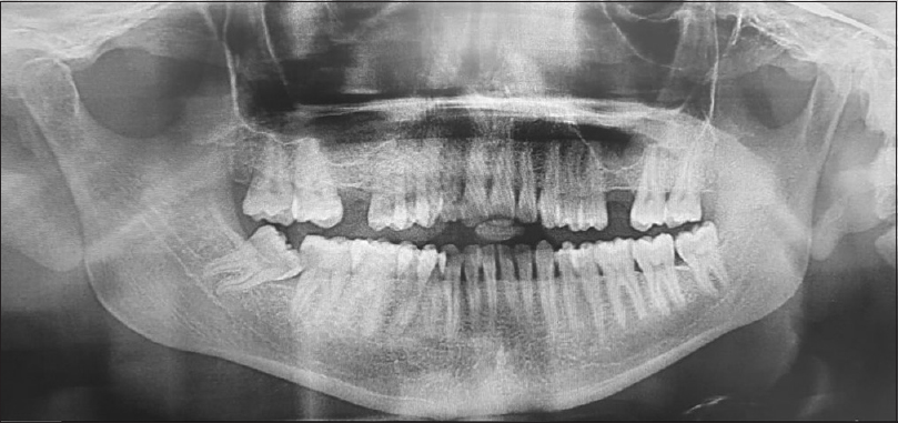 Mesioangular-impaction