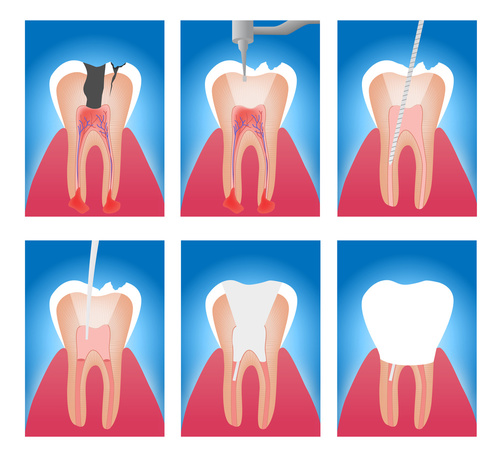 Symptoms for Root Canal Treatment