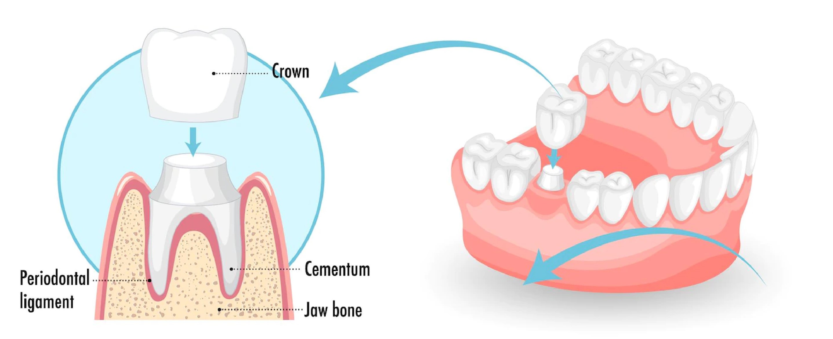 What are Dental Crowns?