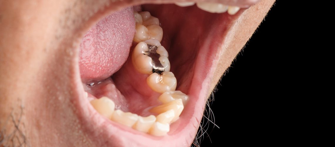 What are the Precautions for Tooth Filling?