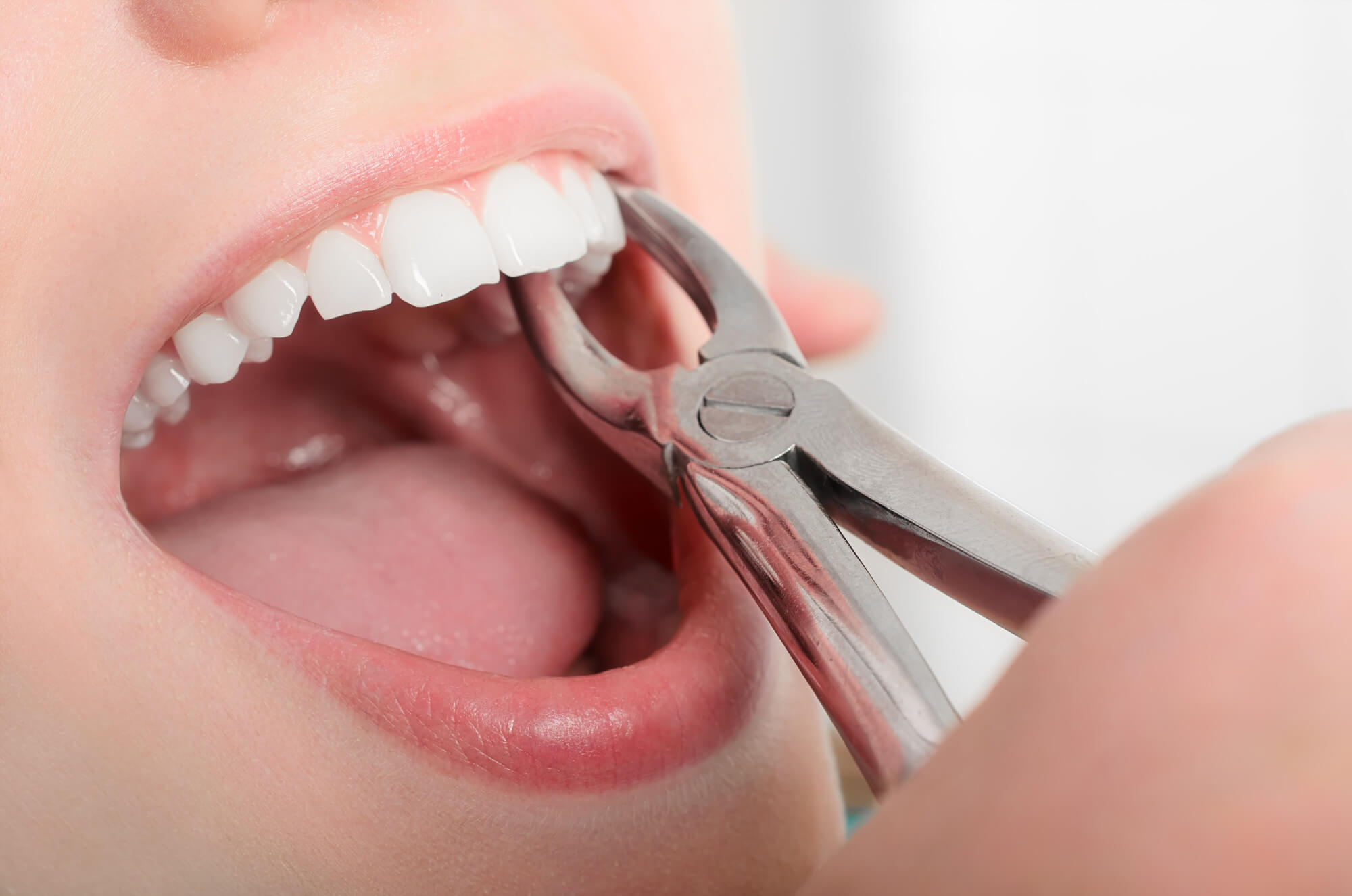 What is a Tooth Extraction?