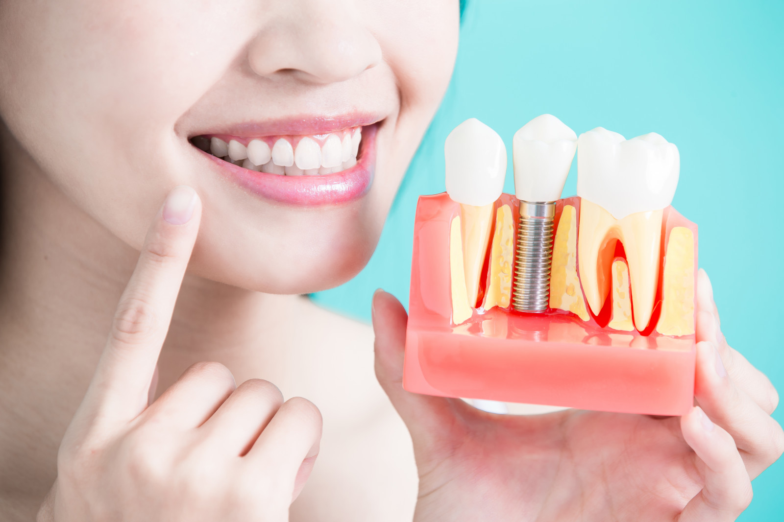 What is the Importance of Dental Implants?