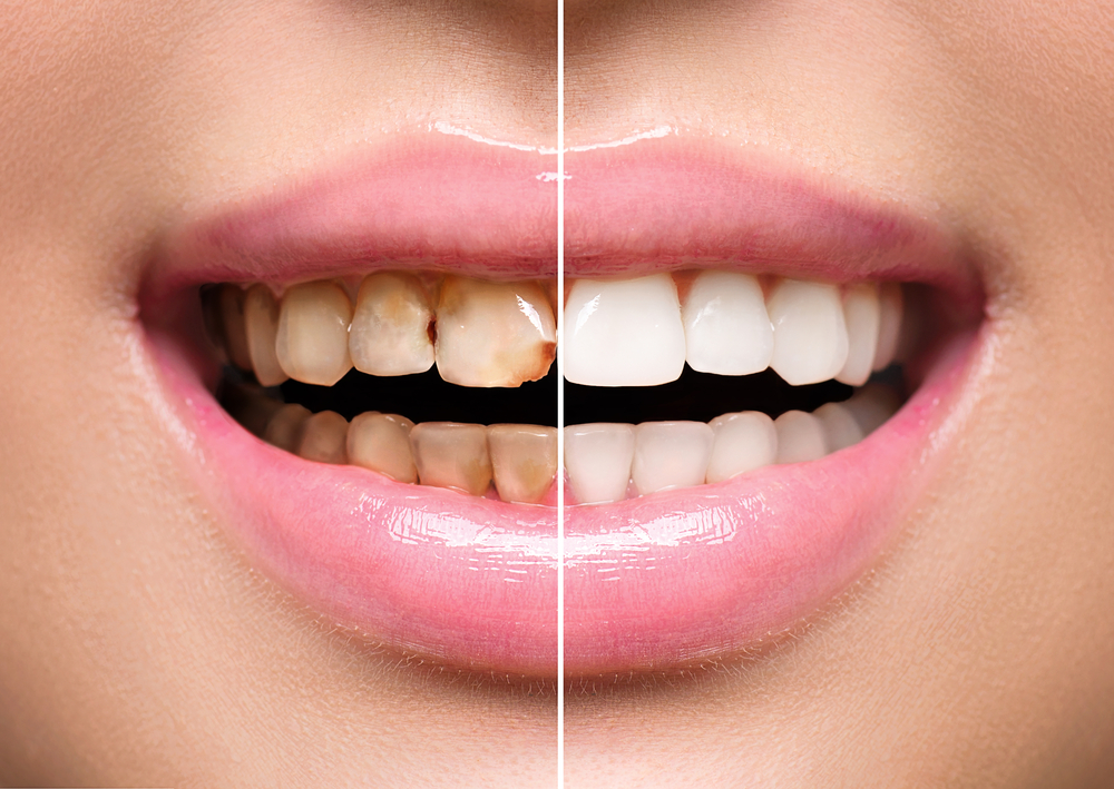 What is the benefit of Teeth Scaling?