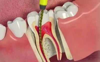 When do you need Root Canal Treatment?