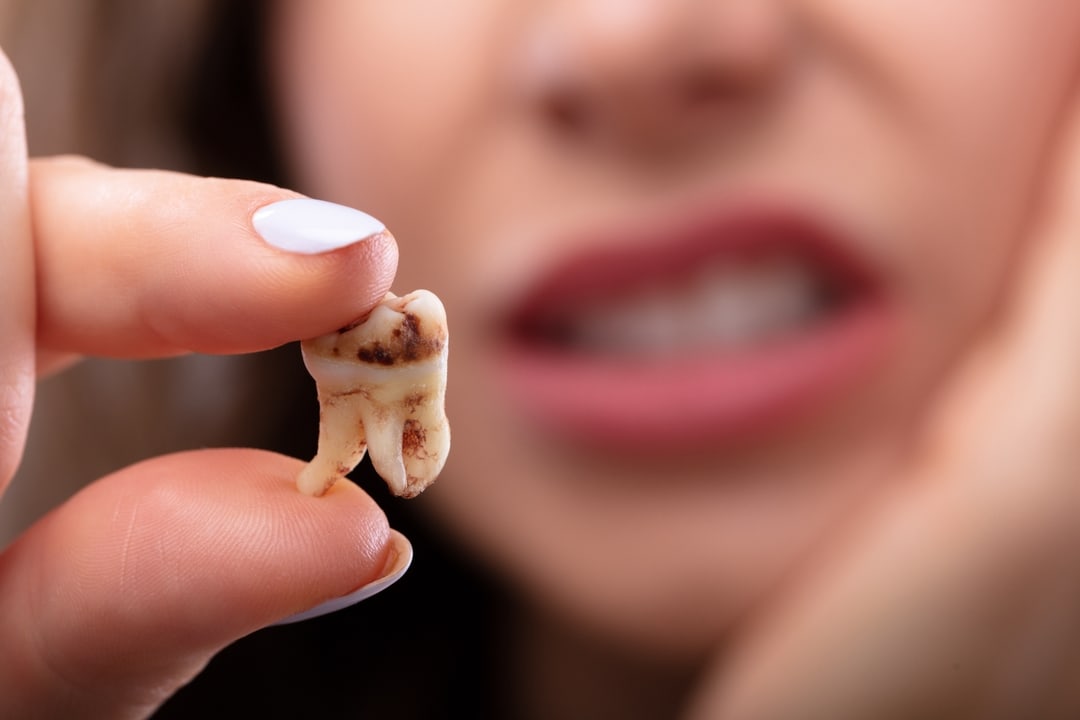 When would you Need Dental Crowns?