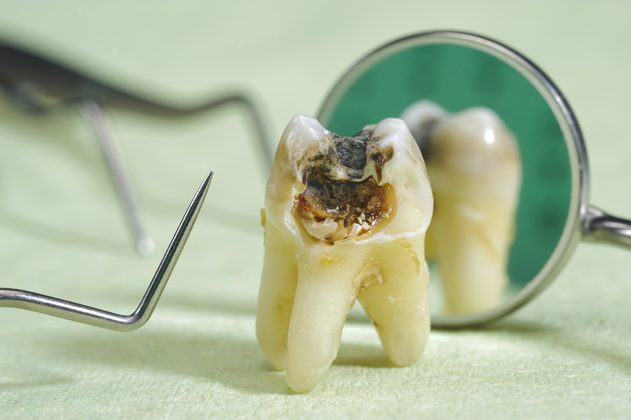 When would you Need Dental Crowns?