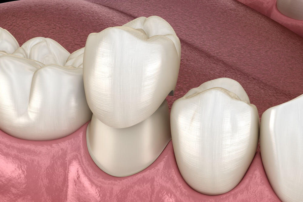 What are the precautions for a Root Canal with a crown?