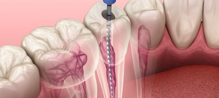 What is the procedure for a Root Canal without a crown?