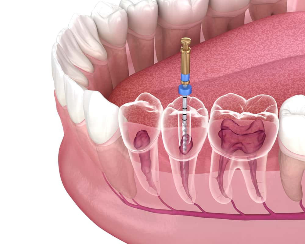 Root Canal Treatment without Crown